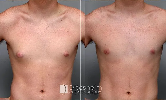 Gynecomastia before & after by Ditesheim Cosmetic Surgery