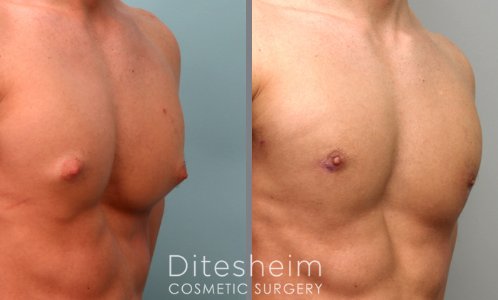Gynecomastia before & after photos, body builder showing nipple change