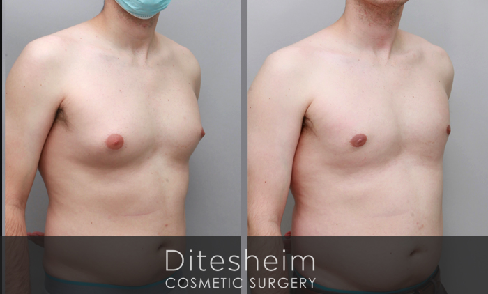 Gynecomastia before & after photos, treatment with VaserLipo