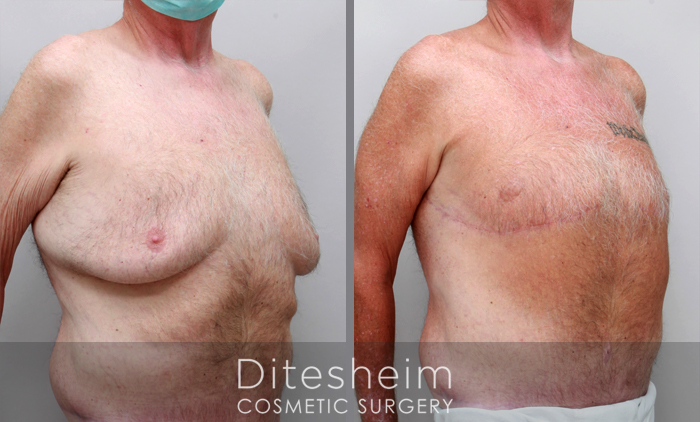 Gynecomastia before & after photos, hanging breasts after large weight loss