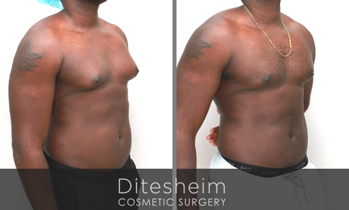 Gynecomastia before & after photos, young black male