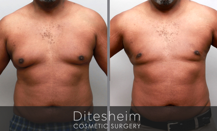 Gynecomastia before & after photos, age 50 reshaping chest front view
