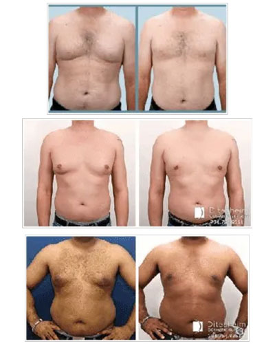Grade 2 Gynecomastia before & after photos