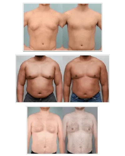 Grade 3 Gynecomastia before & after photos
