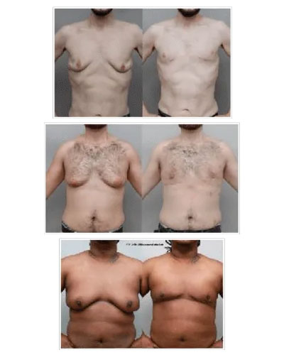 Grade 4 Gynecomastia before & after photos